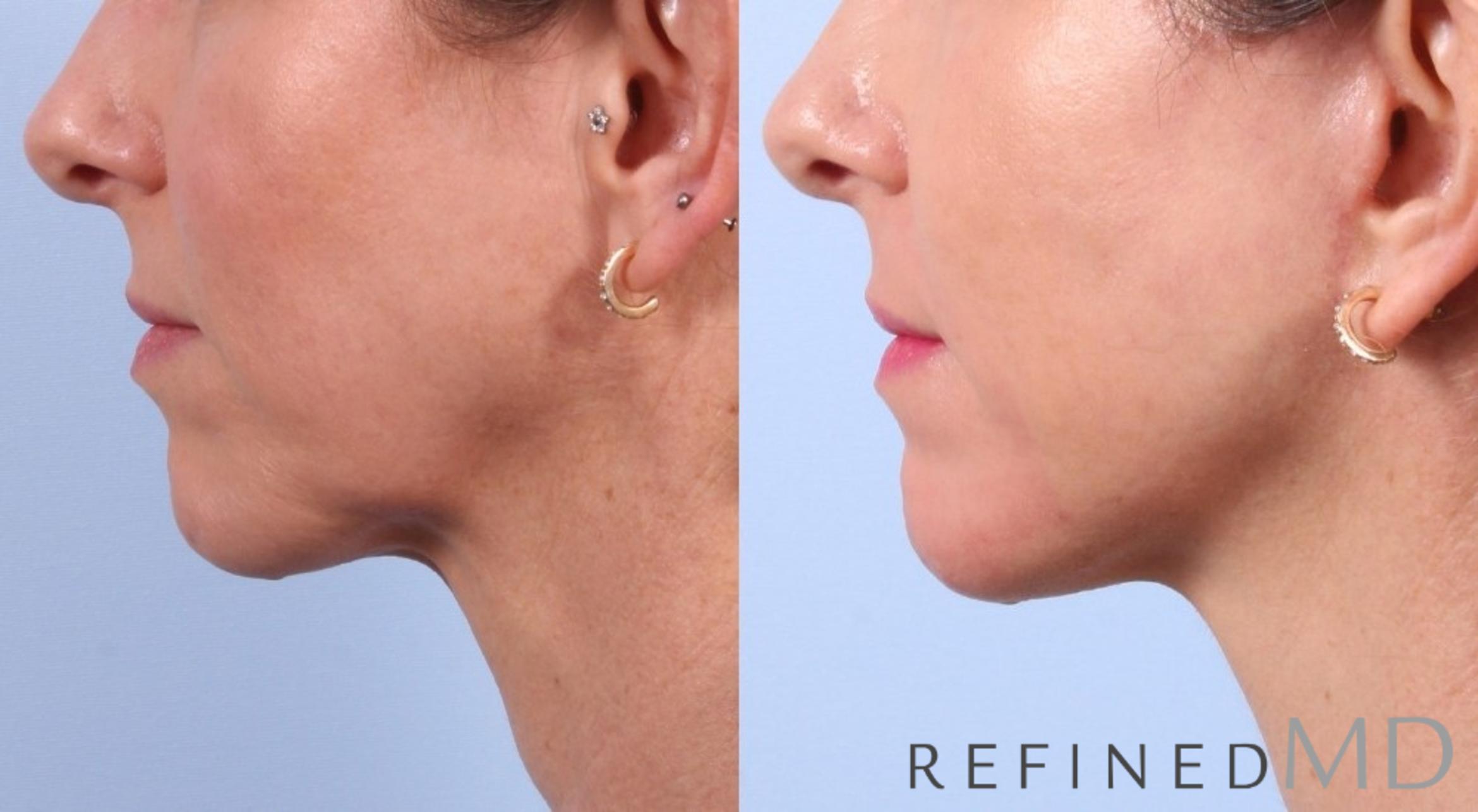 Before & After Facelift Case 1040 View 2 View in Los Gatos & San Jose, CA