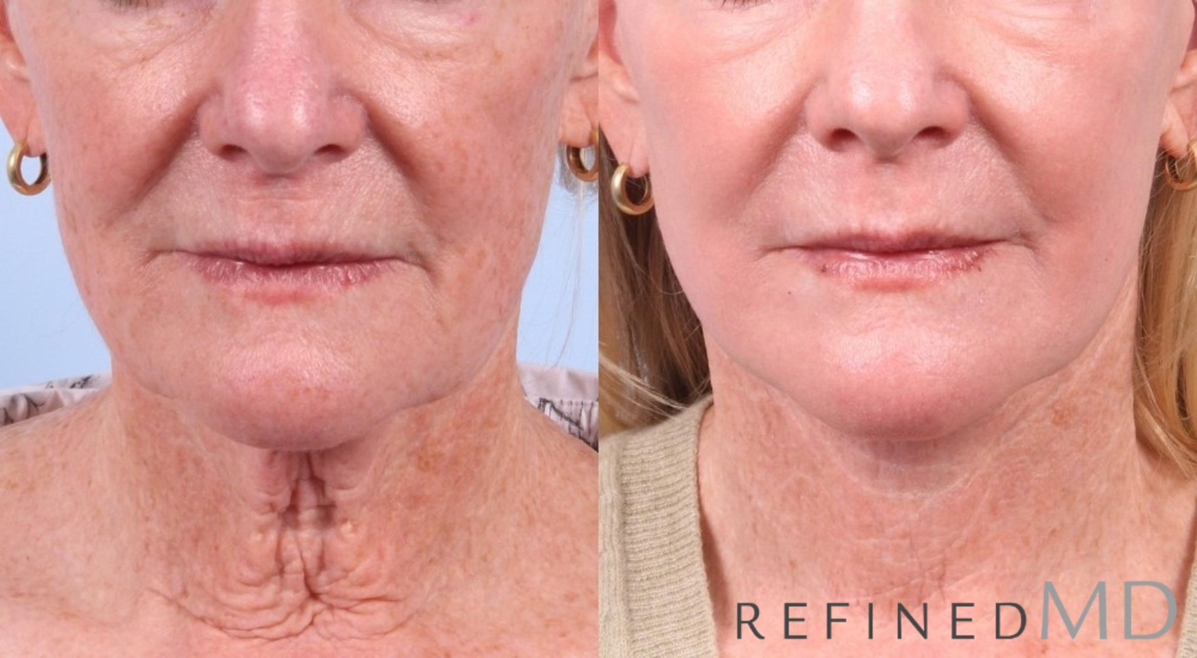 Before & After Facelift Case 1041 View 1 View in Los Gatos & San Jose, CA