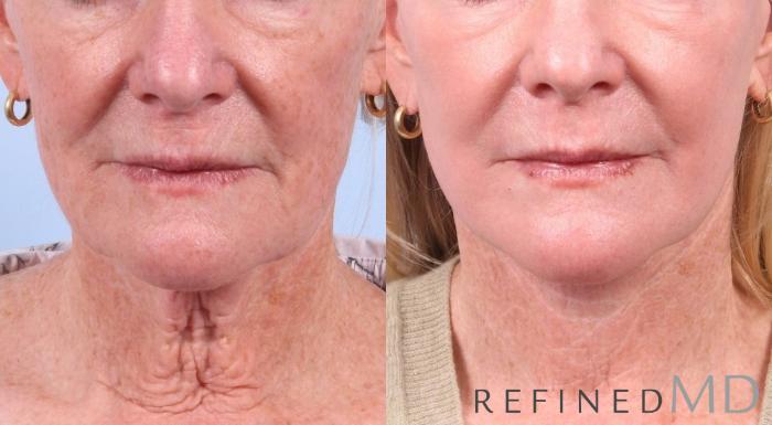 Before & After Facelift Case 1041 View 1 View in Los Gatos & San Jose, CA
