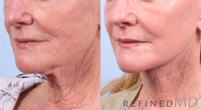 Before & After Facelift Case 1041 View 2 View in Los Gatos & San Jose, CA