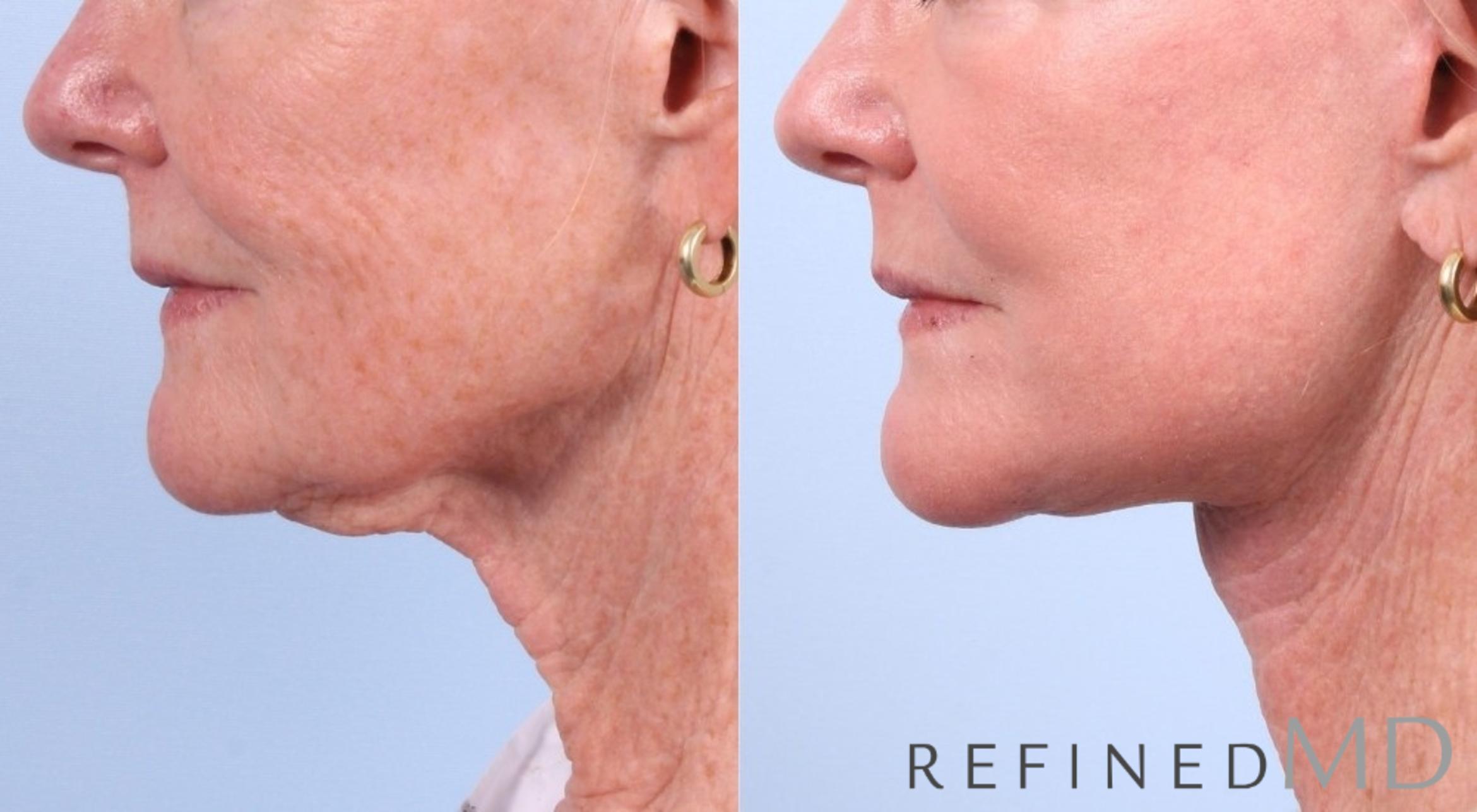 Before & After Facelift Case 1041 View 3 View in Los Gatos & San Jose, CA