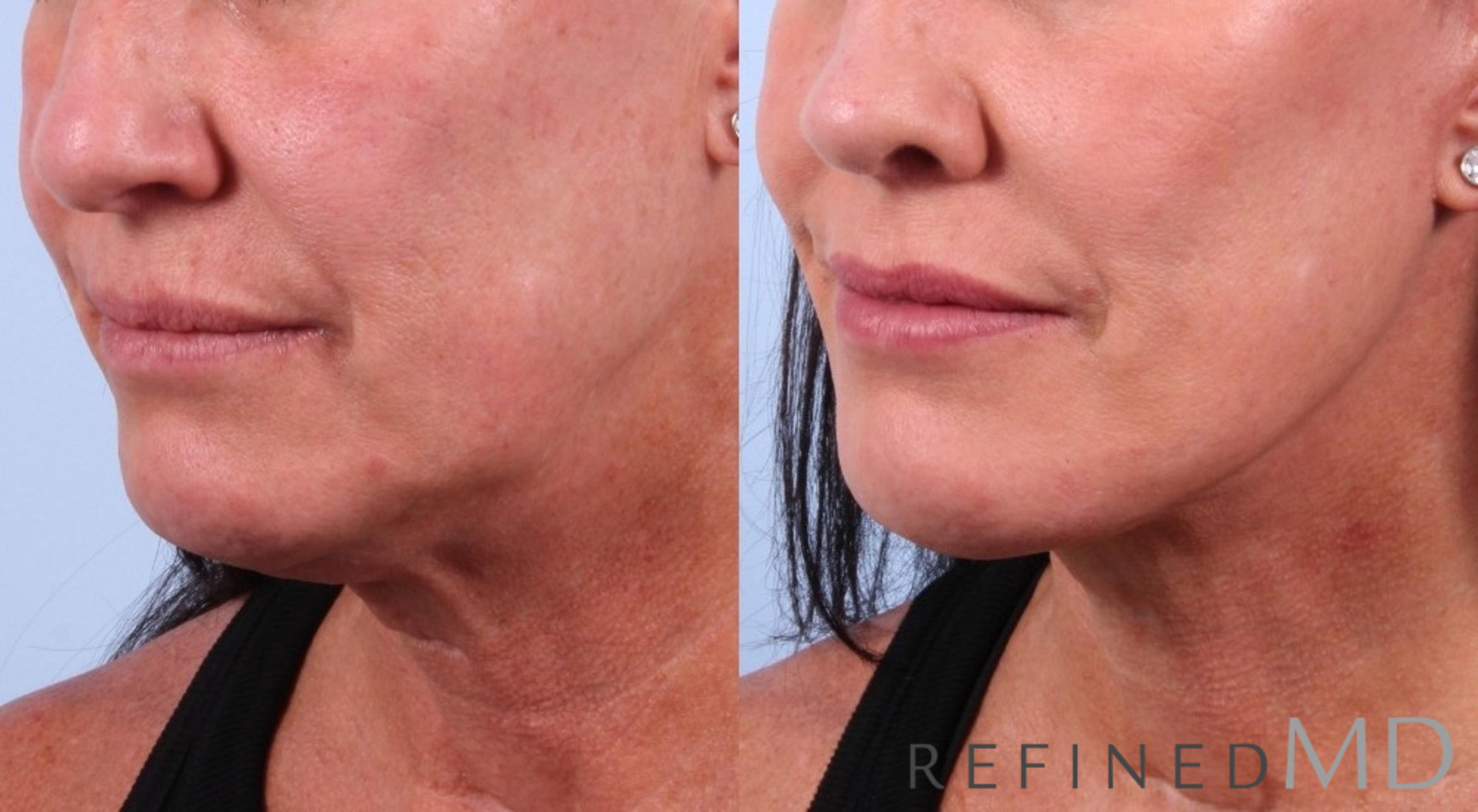 Before & After Facelift Case 1042 View 1 View in Los Gatos & San Jose, CA