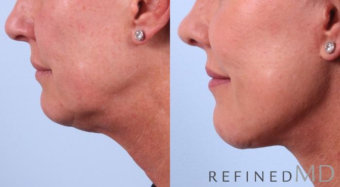 Before & After Facelift Case 1042 View 2 View in Los Gatos & San Jose, CA