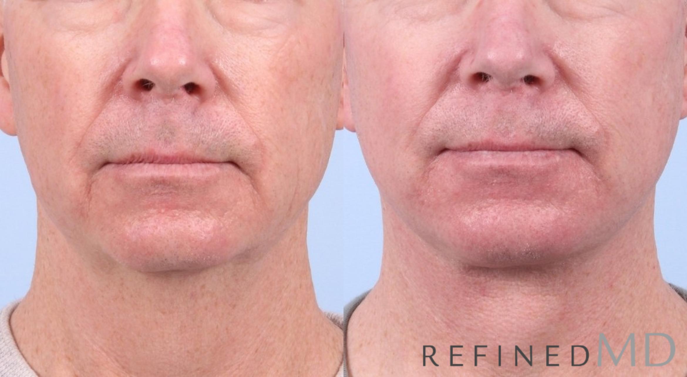 Before & After Facelift Case 1043 View 1 View in Los Gatos & San Jose, CA