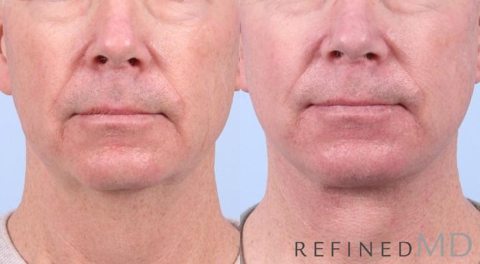 Before & After Facelift Case 1043 View 1 View in Los Gatos & San Jose, CA