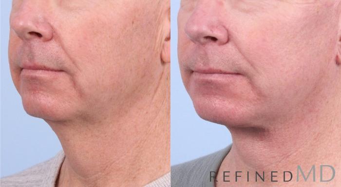 Before & After Facelift Case 1043 View 2 View in Los Gatos & San Jose, CA