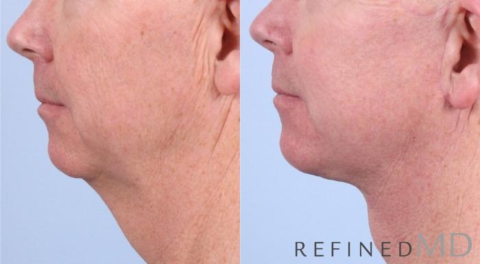 Before & After Facelift Case 1043 View 3 View in Los Gatos & San Jose, CA