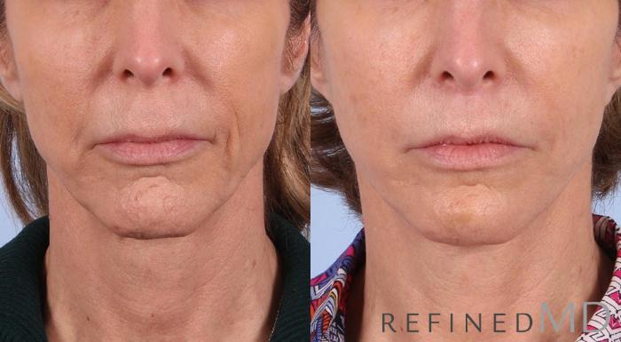 Before & After Facelift Case 1044 View 1 View in Los Gatos & San Jose, CA
