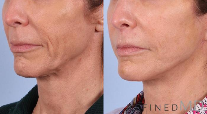 Before & After Facelift Case 1044 View 2 View in Los Gatos & San Jose, CA