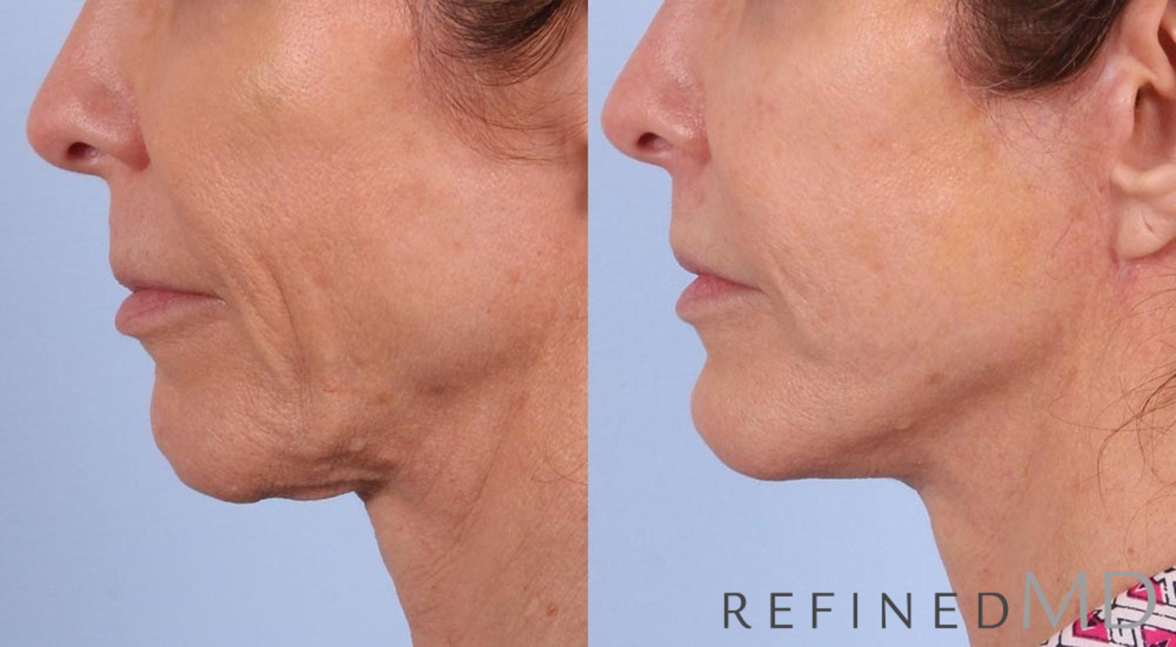Before & After Facelift Case 1044 View 3 View in Los Gatos & San Jose, CA