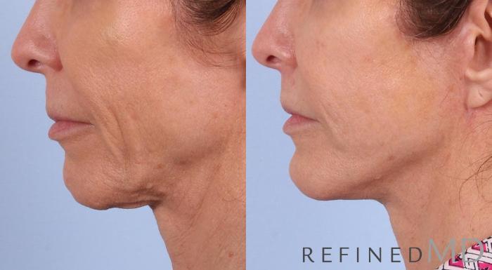 Before & After Facelift Case 1044 View 3 View in Los Gatos & San Jose, CA