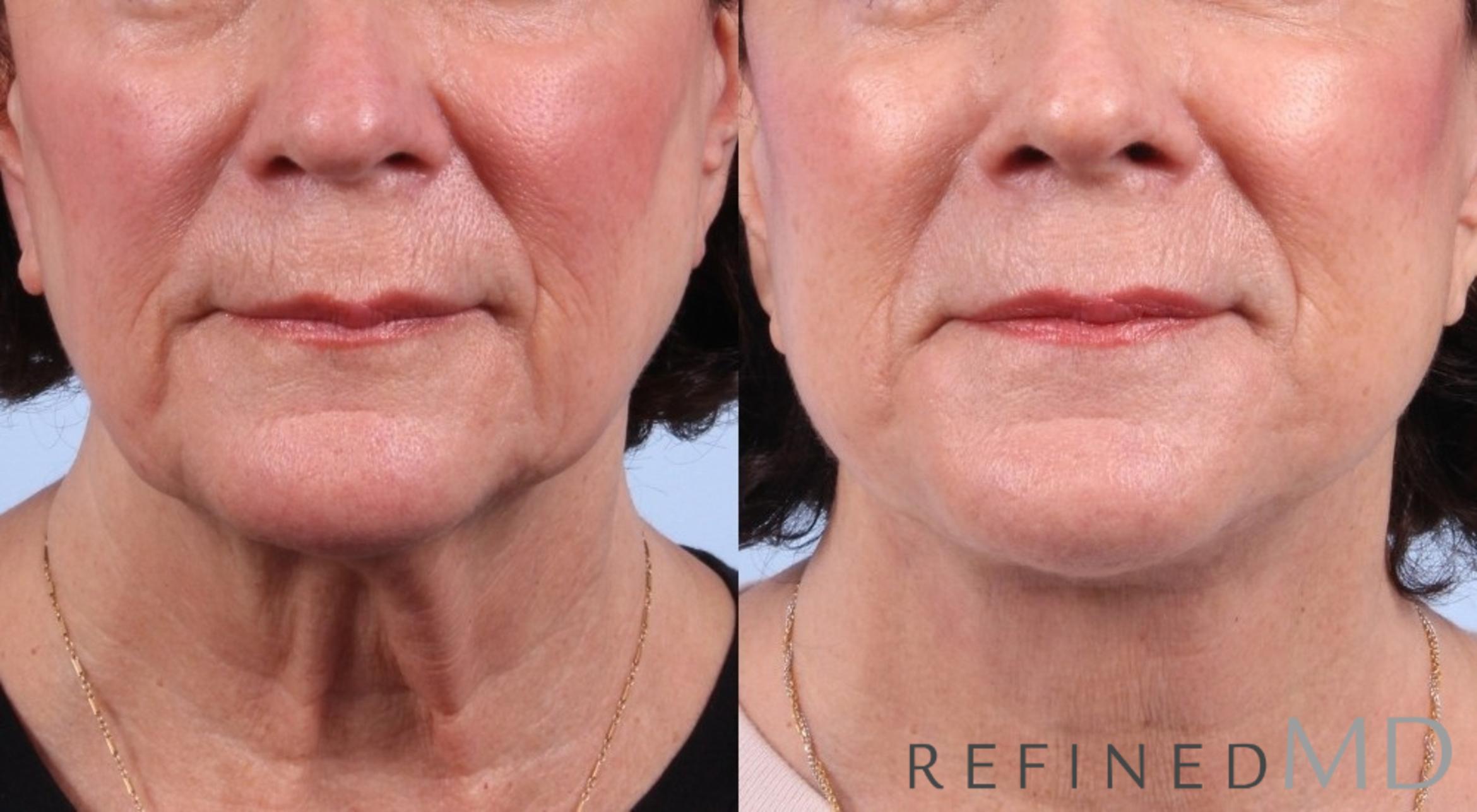 Before & After Facelift Case 1045 View 1 View in Los Gatos & San Jose, CA
