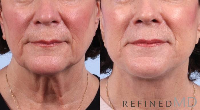 Before & After Facelift Case 1045 View 1 View in Los Gatos & San Jose, CA