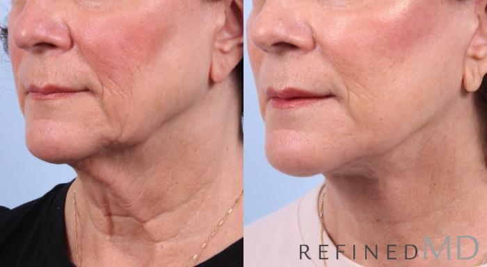 Before & After Facelift Case 1045 View 2 View in Los Gatos & San Jose, CA
