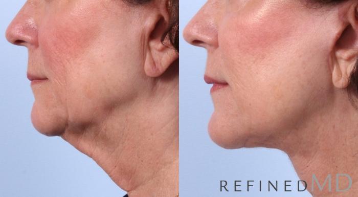 Before & After Facelift Case 1045 View 3 View in Los Gatos & San Jose, CA