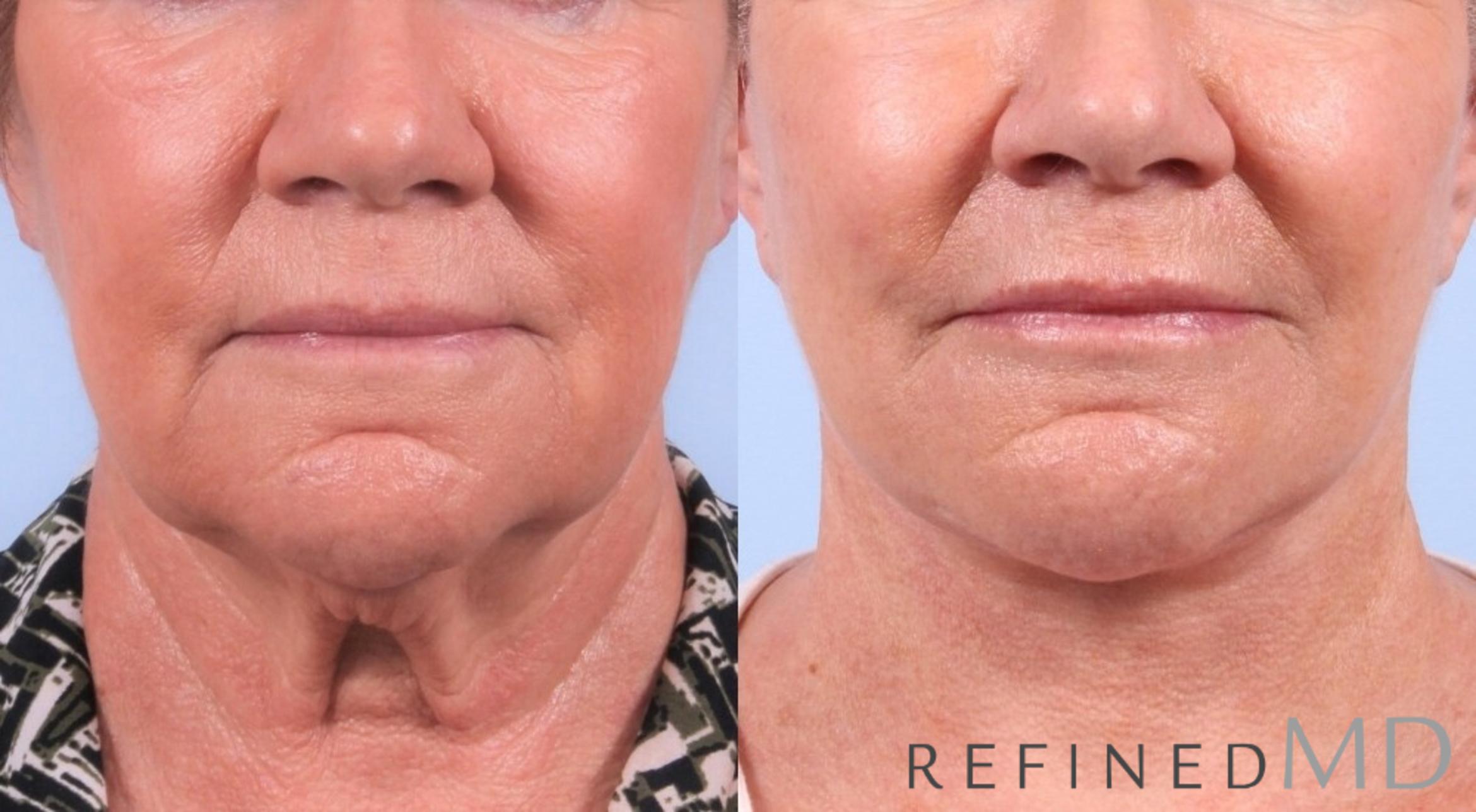Before & After Facelift Case 1046 View 1 View in Los Gatos & San Jose, CA