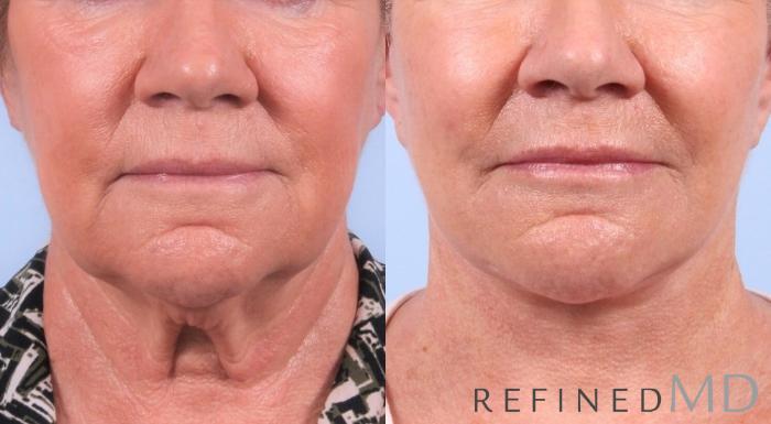 Before & After Facelift Case 1046 View 1 View in Los Gatos & San Jose, CA