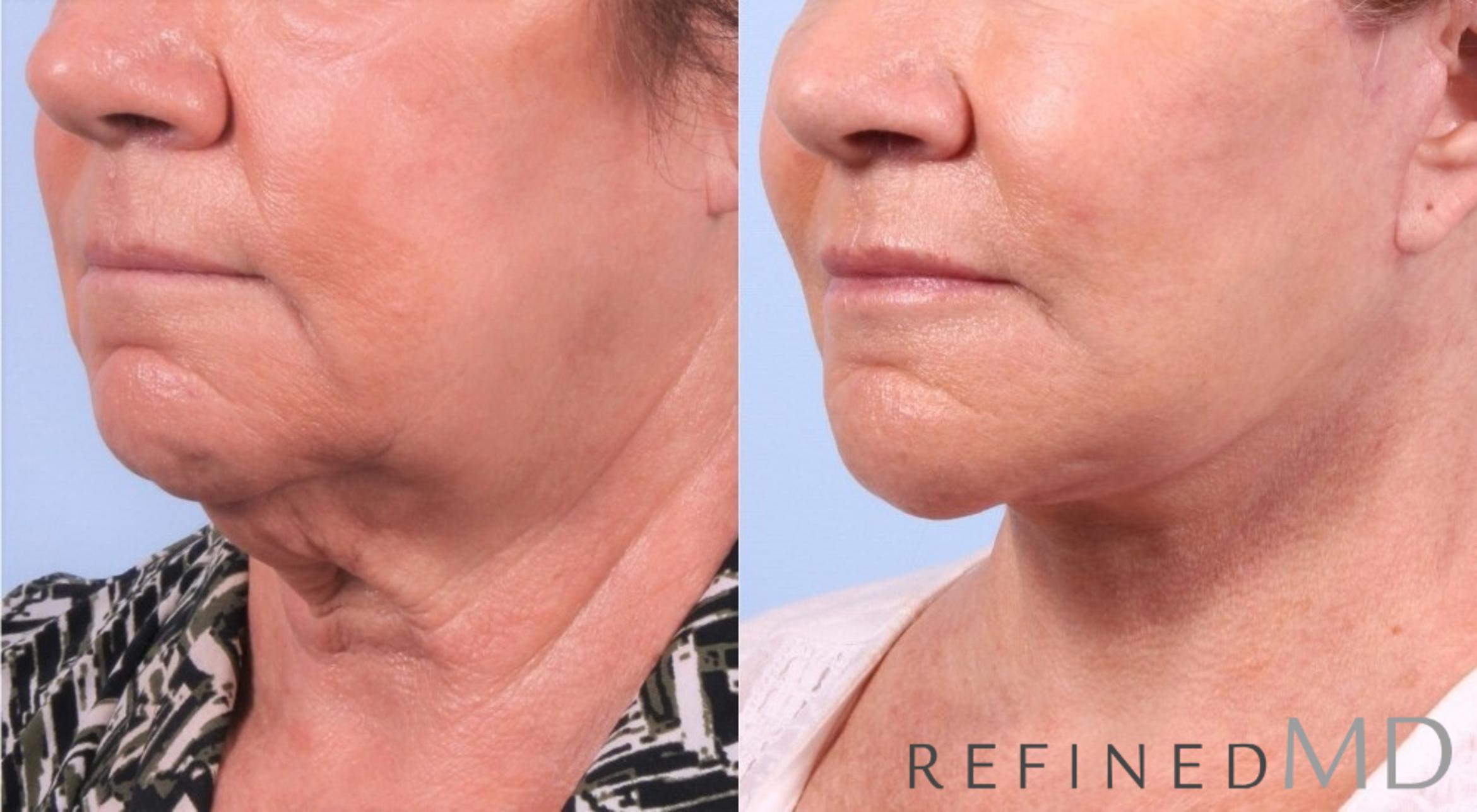 Before & After Facelift Case 1046 View 2 View in Los Gatos & San Jose, CA