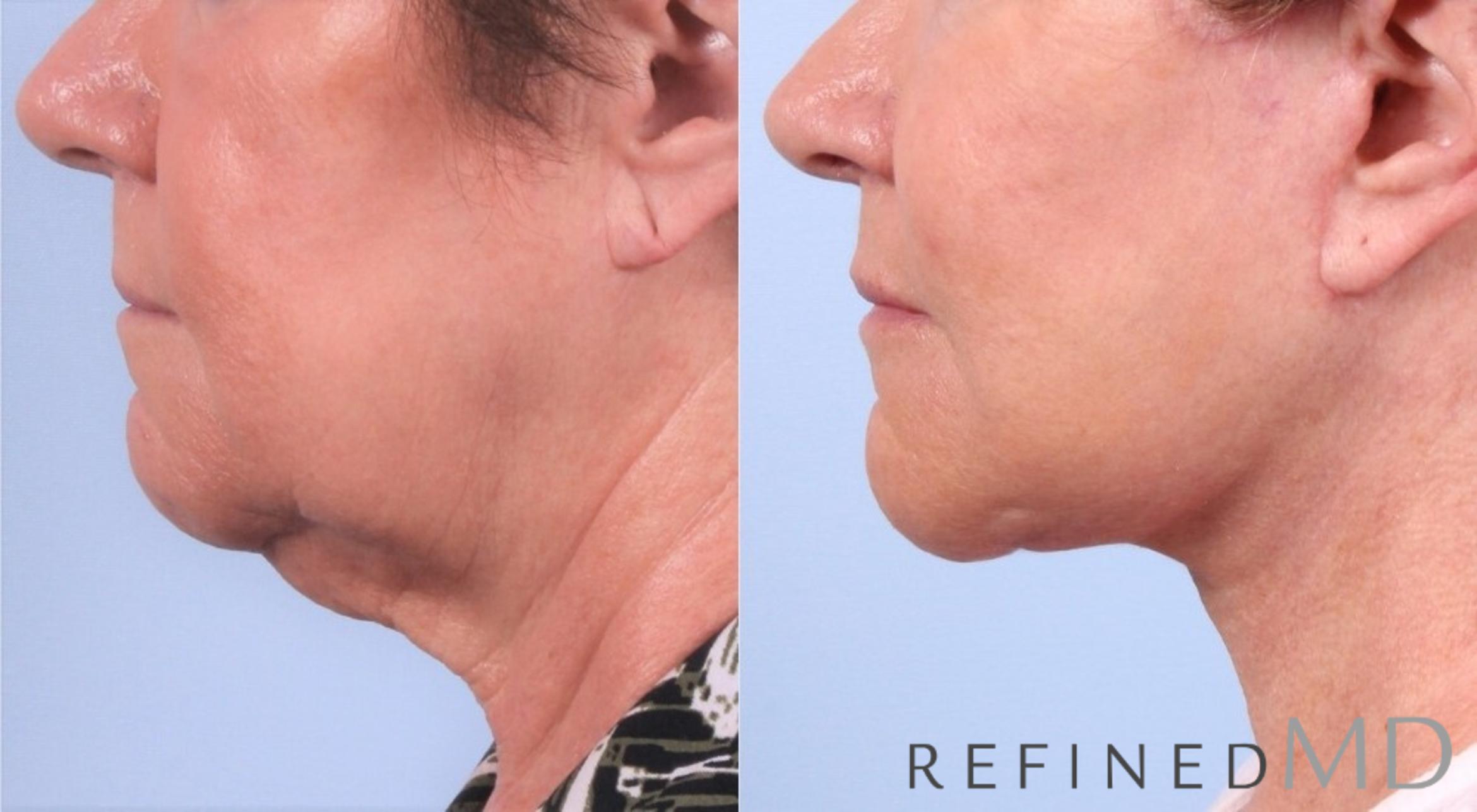 Before & After Facelift Case 1046 View 3 View in Los Gatos & San Jose, CA