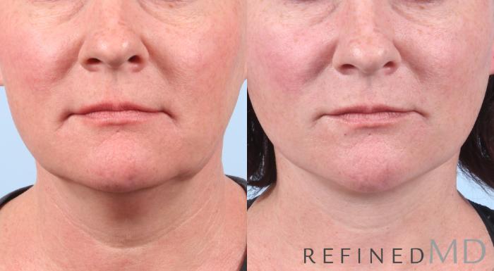 Before & After Facelift Case 1047 View 1 View in Los Gatos & San Jose, CA