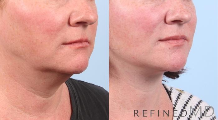 Before & After Facelift Case 1047 View 2 View in Los Gatos & San Jose, CA