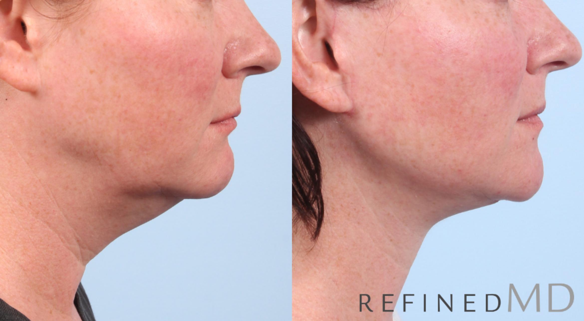 Before & After Facelift Case 1047 View 3 View in Los Gatos & San Jose, CA