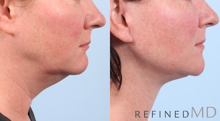 Before & After Facelift Case 1047 View 3 View in Los Gatos & San Jose, CA