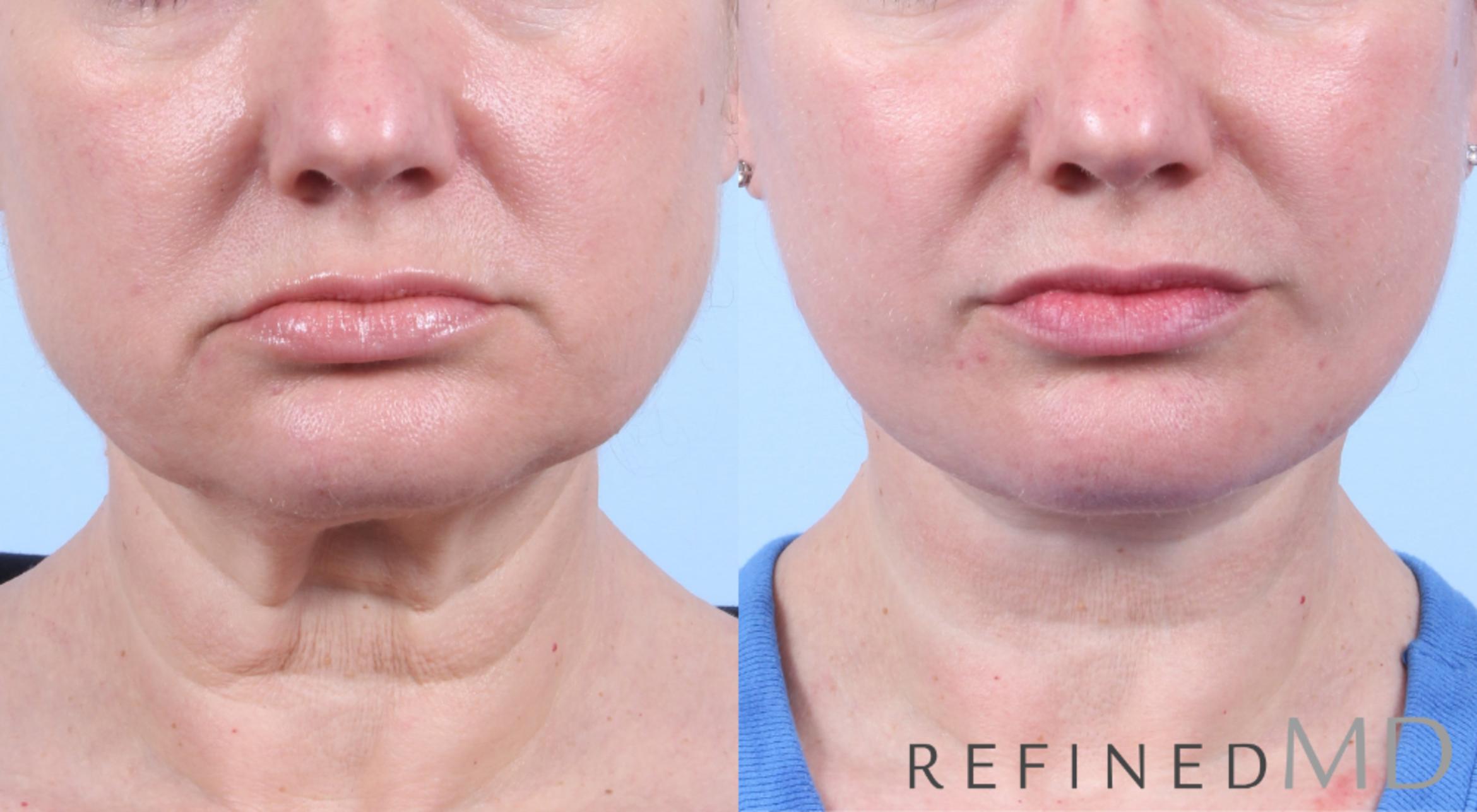 Before & After Facelift Case 1048 View 1 View in Los Gatos & San Jose, CA