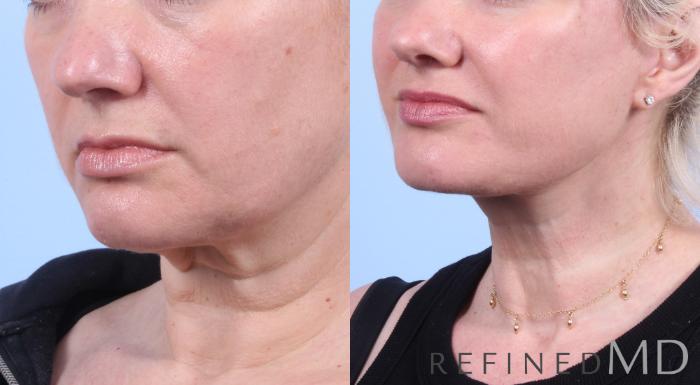 Before & After Facelift Case 1048 View 2 View in Los Gatos & San Jose, CA