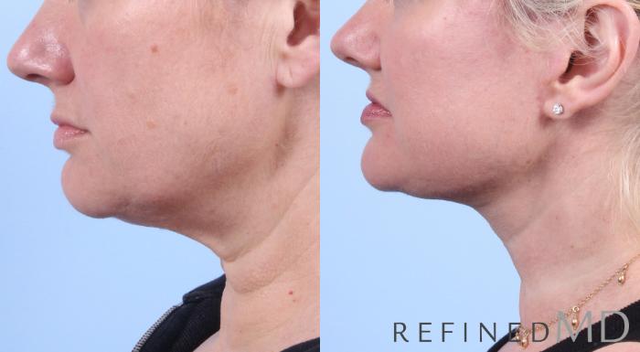 Before & After Facelift Case 1048 View 3 View in Los Gatos & San Jose, CA