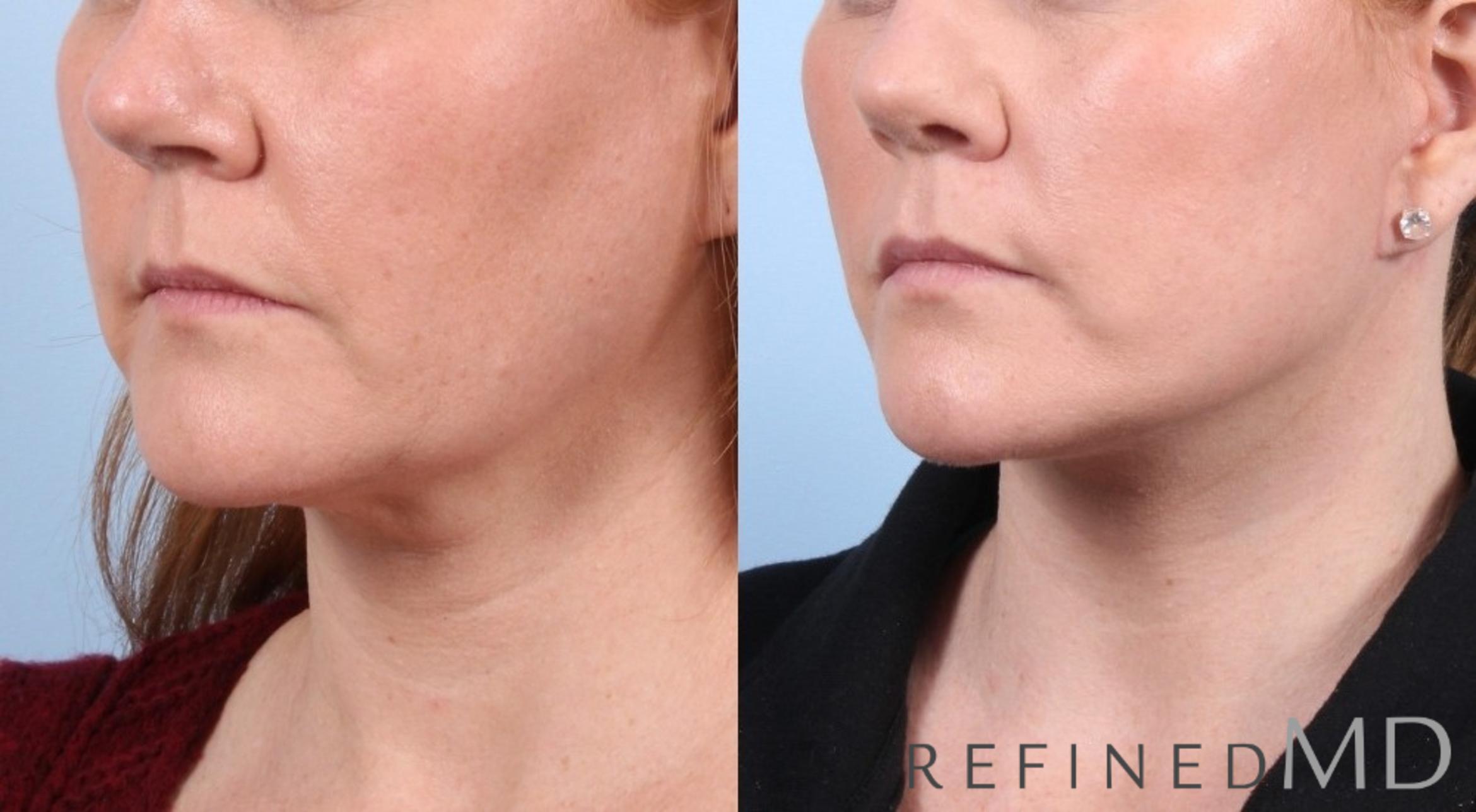 Before & After Facelift Case 1049 View 1 View in Los Gatos & San Jose, CA