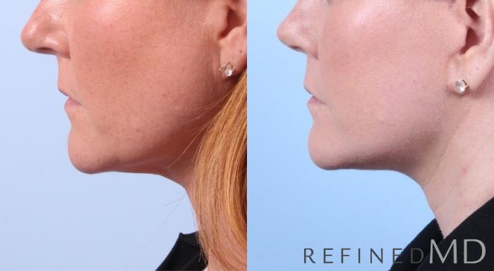 Before & After Facelift Case 1049 View 2 View in Los Gatos & San Jose, CA