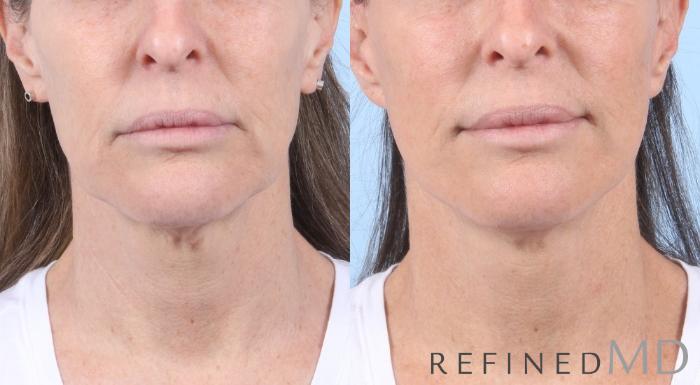 Before & After Facelift Case 1050 View 1 View in Los Gatos & San Jose, CA