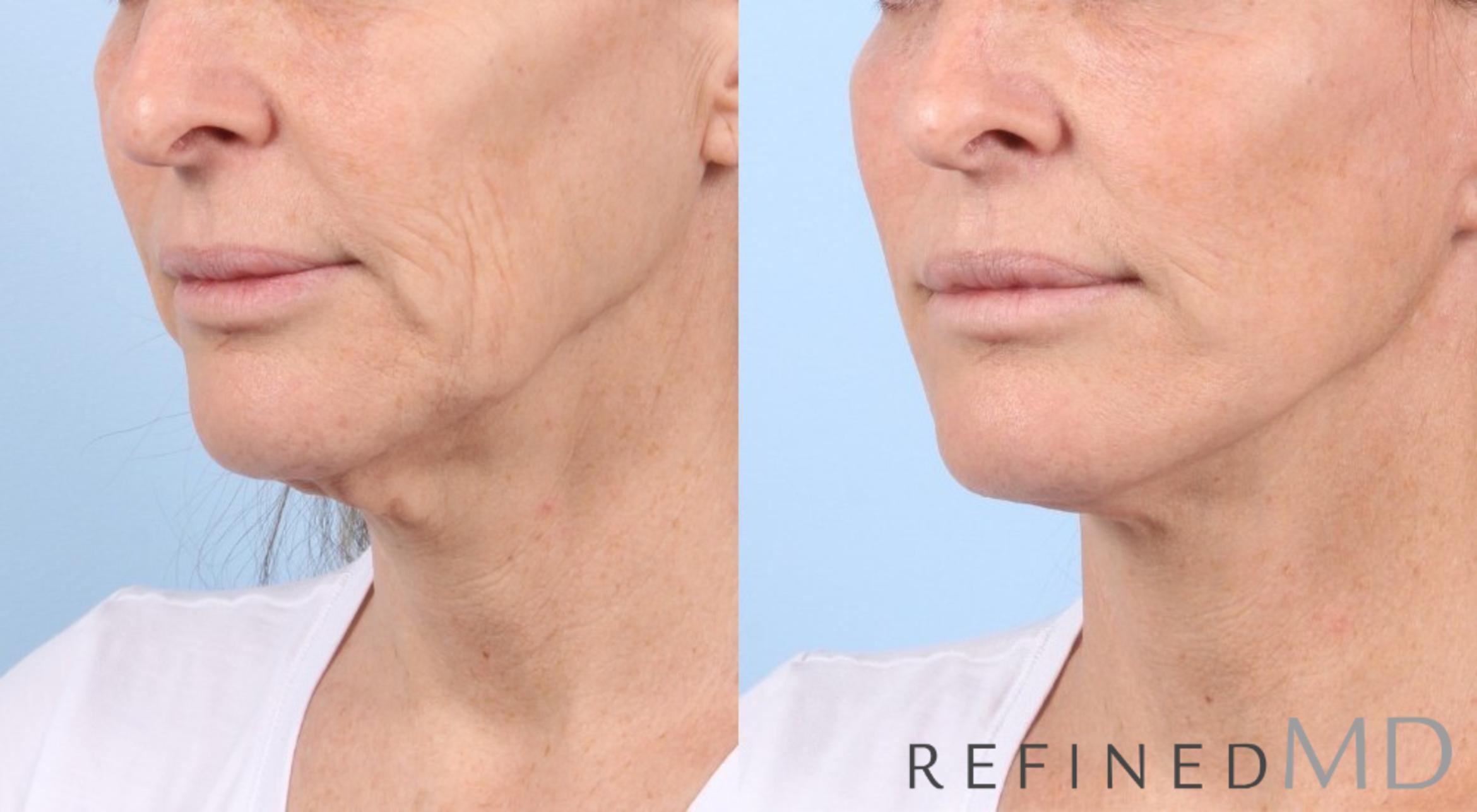 Before & After Facelift Case 1050 View 2 View in Los Gatos & San Jose, CA