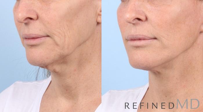 Before & After Facelift Case 1050 View 2 View in Los Gatos & San Jose, CA