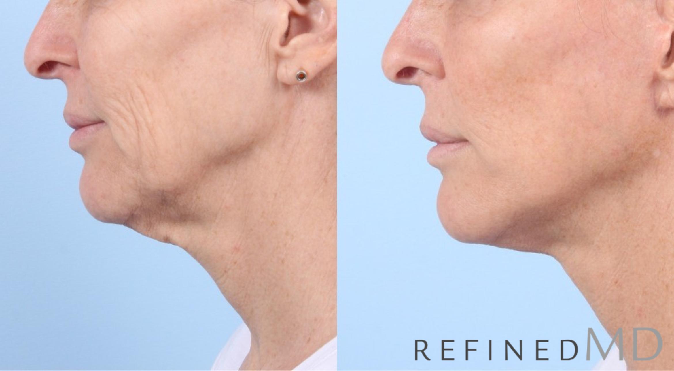 Before & After Facelift Case 1050 View 3 View in Los Gatos & San Jose, CA
