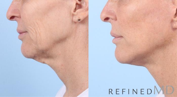 Before & After Facelift Case 1050 View 3 View in Los Gatos & San Jose, CA