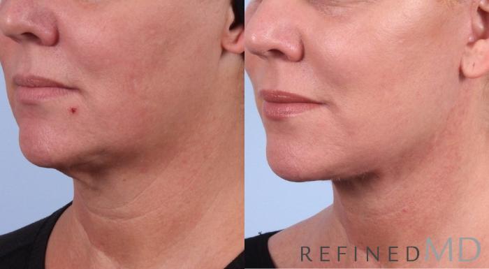 Before & After Facelift Case 1051 View 1 View in Los Gatos & San Jose, CA