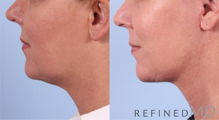 Before & After Facelift Case 1051 View 2 View in Los Gatos & San Jose, CA