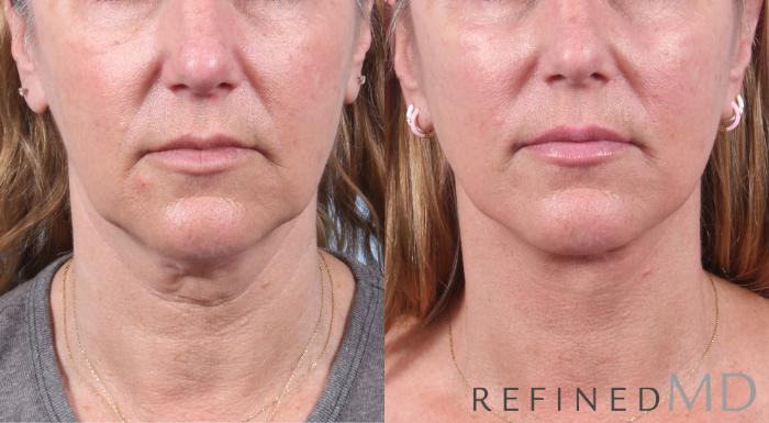Before & After Facelift Case 1052 View 1 View in Los Gatos & San Jose, CA