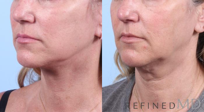 Before & After Facelift Case 1052 View 2 View in Los Gatos & San Jose, CA