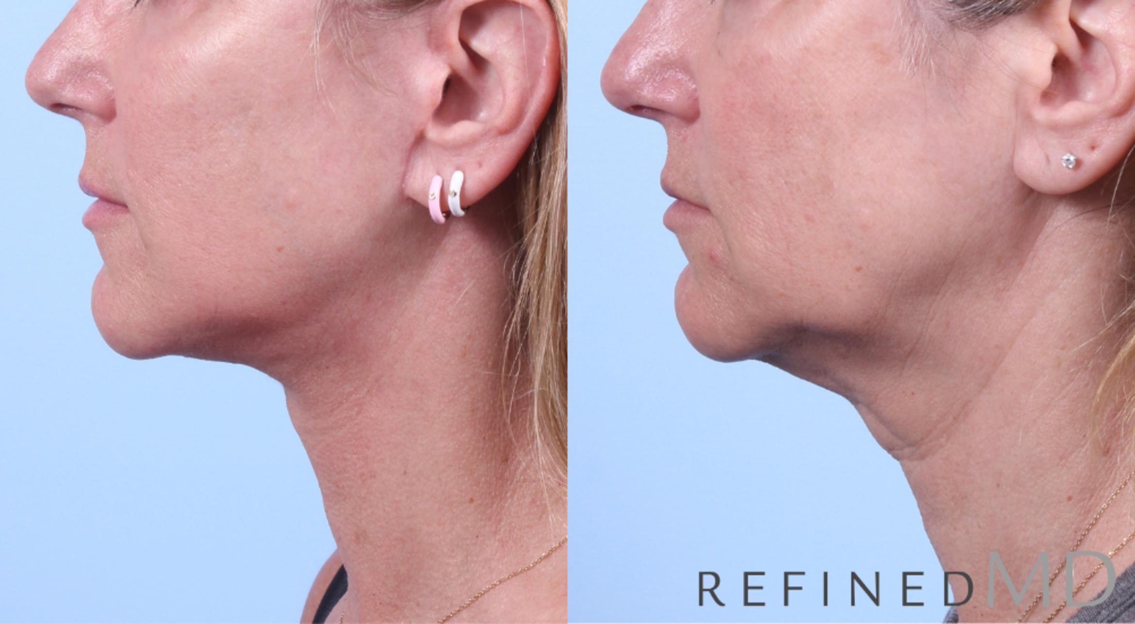 Before & After Facelift Case 1052 View 3 View in Los Gatos & San Jose, CA