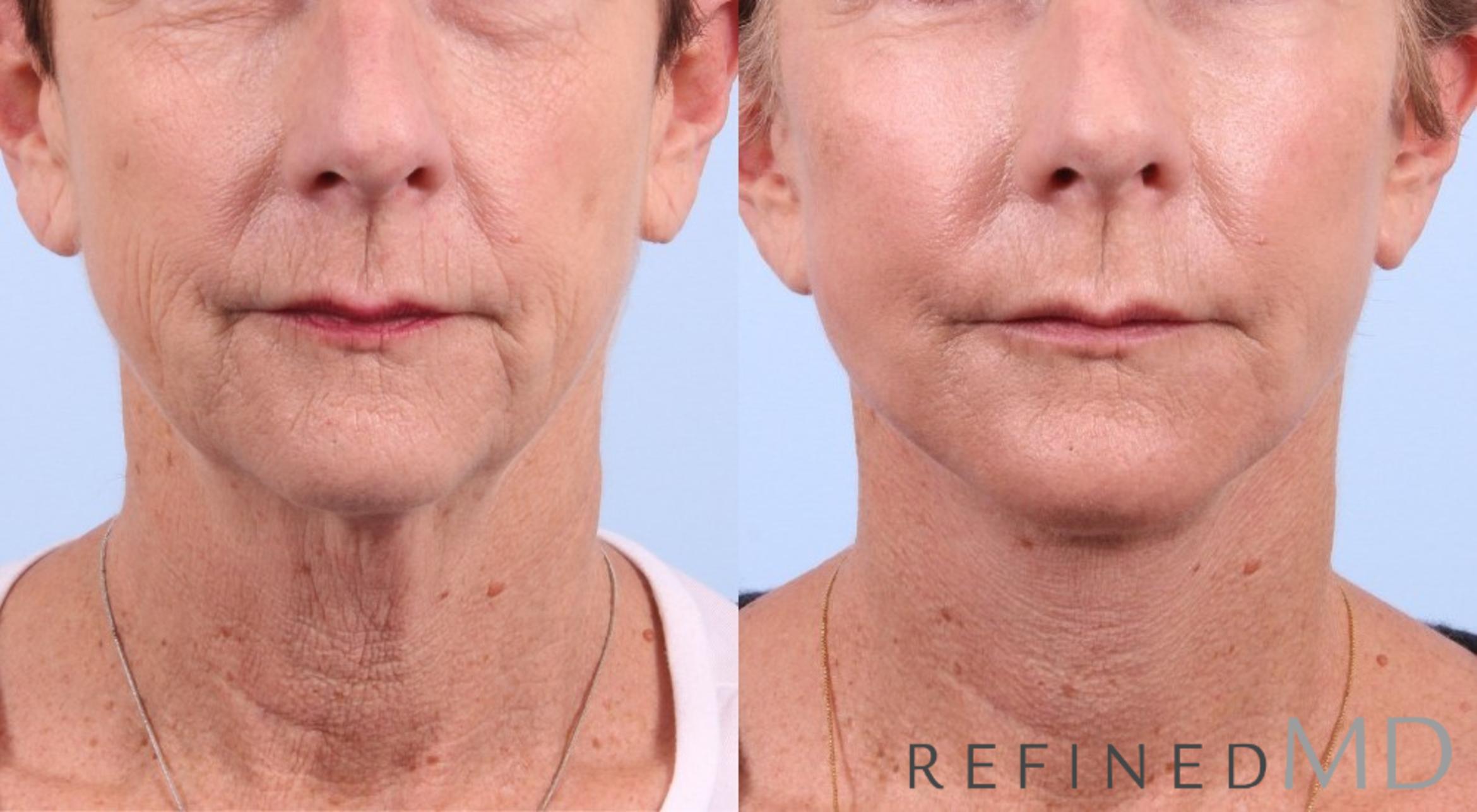 Before & After Facelift Case 1053 View 1 View in Los Gatos & San Jose, CA