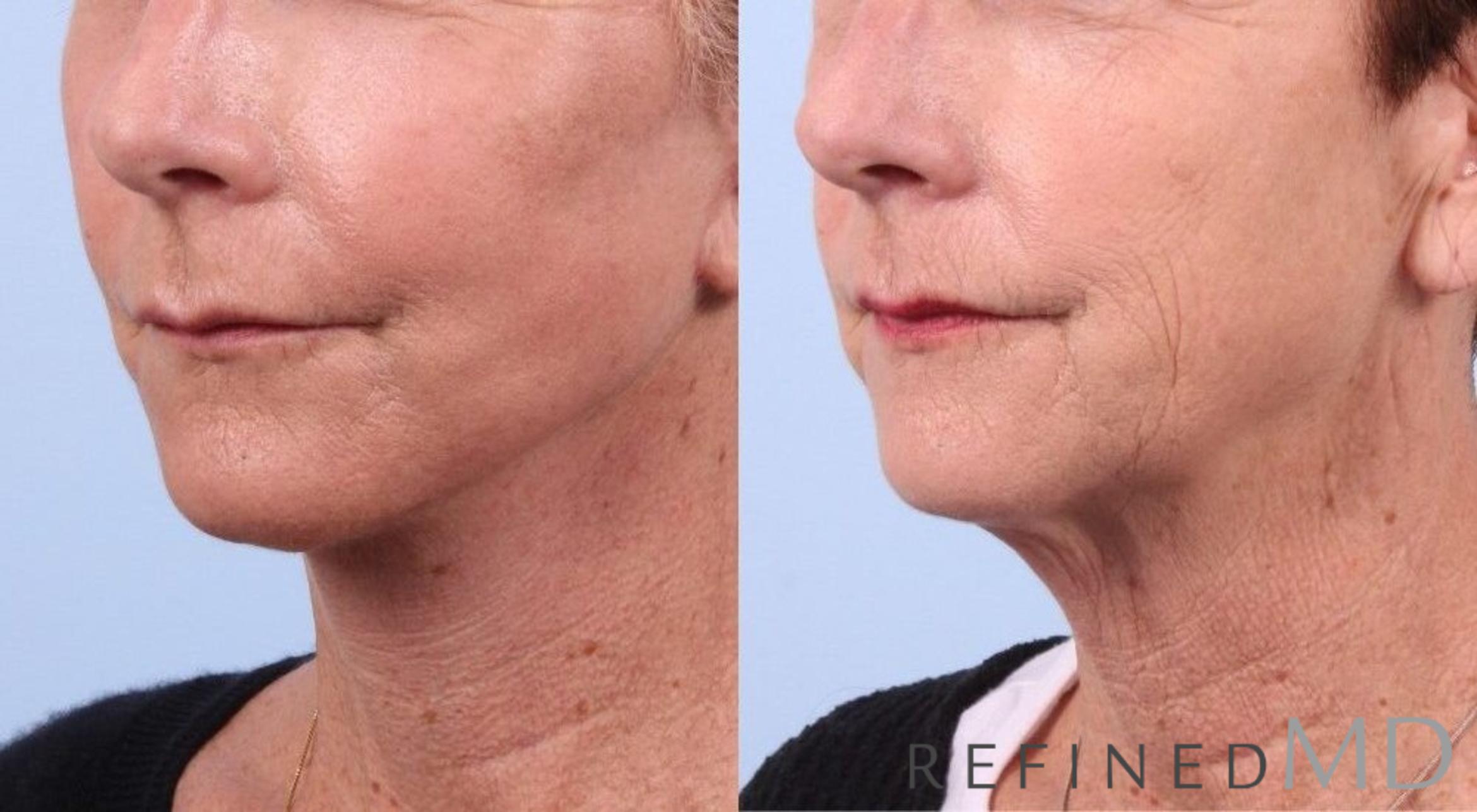 Before & After Facelift Case 1053 View 2 View in Los Gatos & San Jose, CA