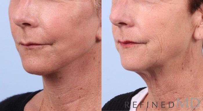 Before & After Facelift Case 1053 View 2 View in Los Gatos & San Jose, CA