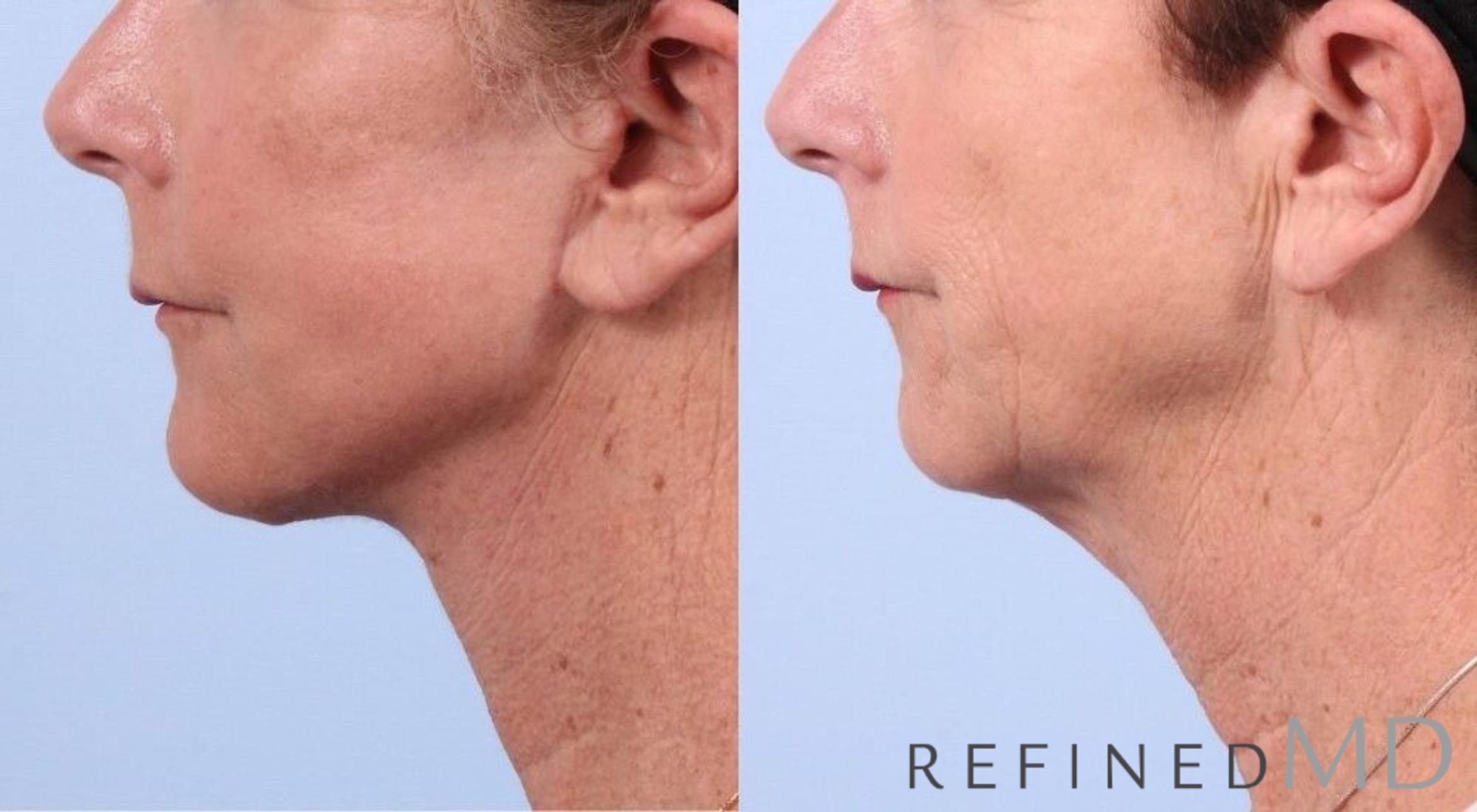 Before & After Facelift Case 1053 View 3 View in Los Gatos & San Jose, CA