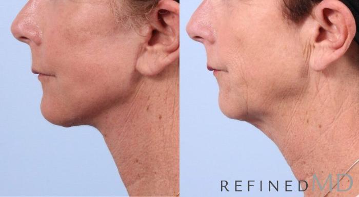 Before & After Facelift Case 1053 View 3 View in Los Gatos & San Jose, CA