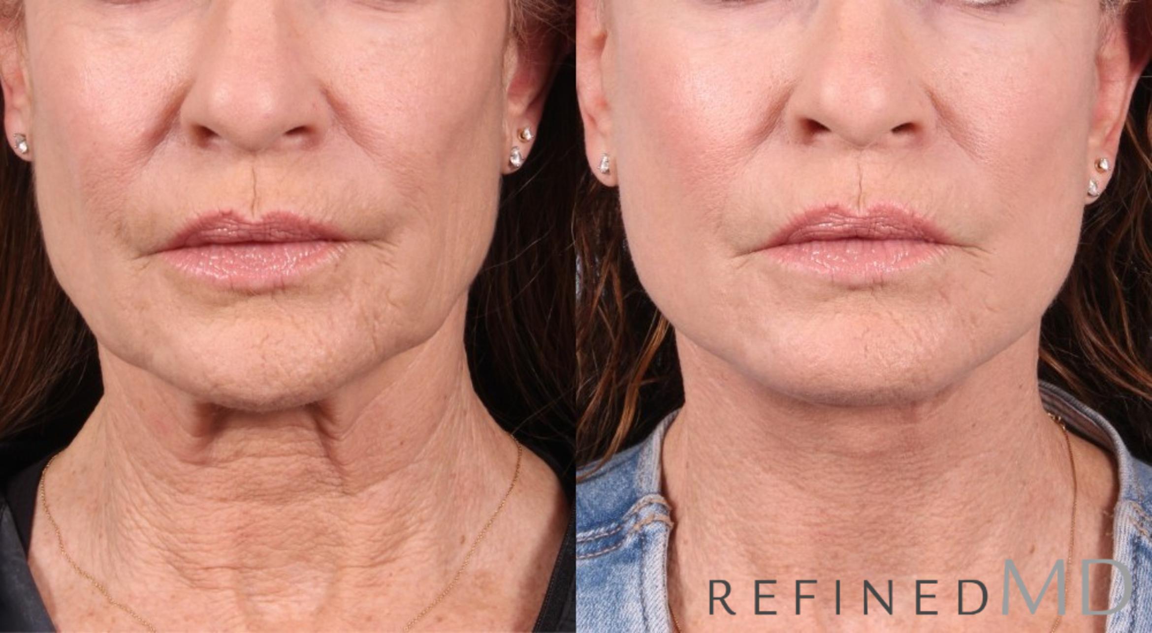 Before & After Facelift Case 1054 View 1 View in Los Gatos & San Jose, CA