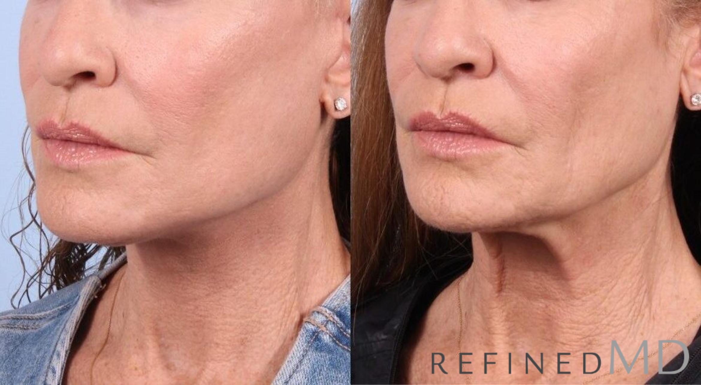 Before & After Facelift Case 1054 View 2 View in Los Gatos & San Jose, CA