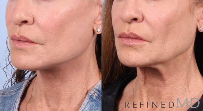 Before & After Facelift Case 1054 View 2 View in Los Gatos & San Jose, CA